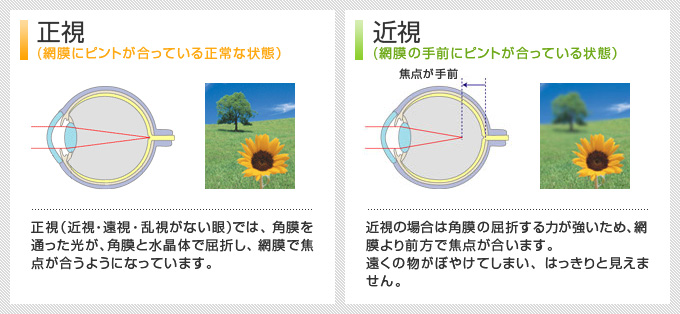 正視(網膜にピントが合っている正常な状態)近視(網膜の手前にピントが合っている状態)