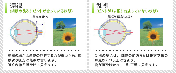 遠視(網膜の後ろにピントが合っている状態)乱視(ピントが一ヶ所に定まっていない状態)
