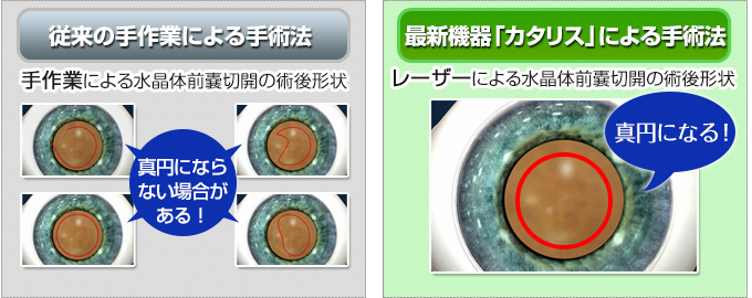 従来の手作業による手術法と最新機器「カタリス」による手術法