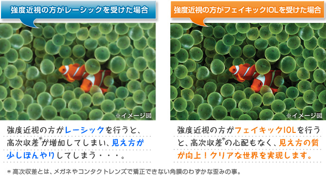 強度近視の方がレーシックを行うと、高次収差が増加してしまい、見え方が少しぼんやりしてしまう。強度近視の方がフェイキックIOLを行うと、高次収差の心配もなく、見え方の質が向上!クリアな世界を実現します。