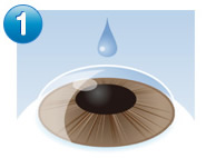 ICL（眼内コンタクトレンズ）手術の流れ 1