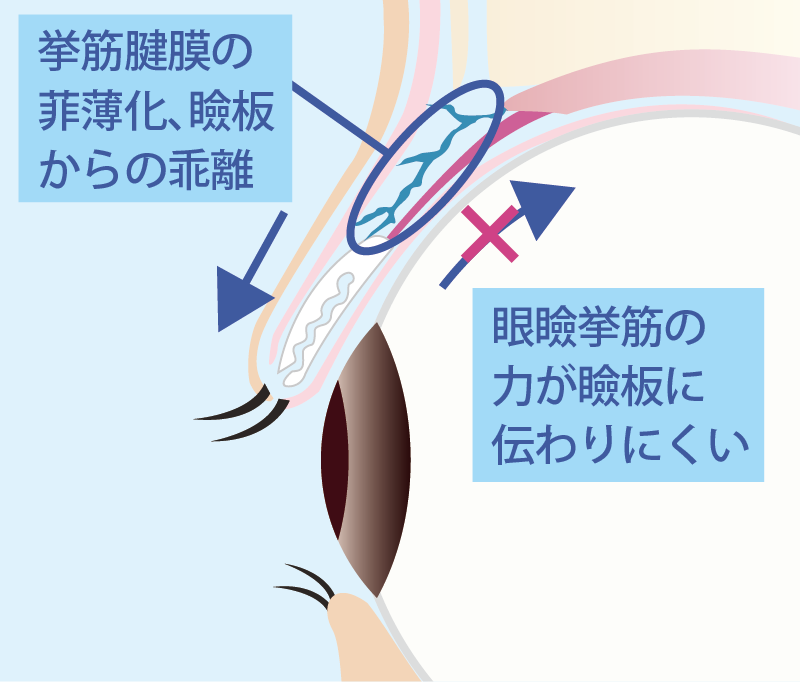 眼瞼下垂の眼