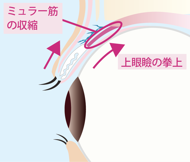 アップニーク点眼後の眼