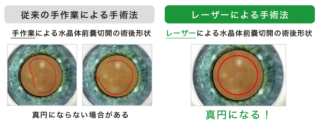 従来の手作業による手術法とレーザーによる手術法