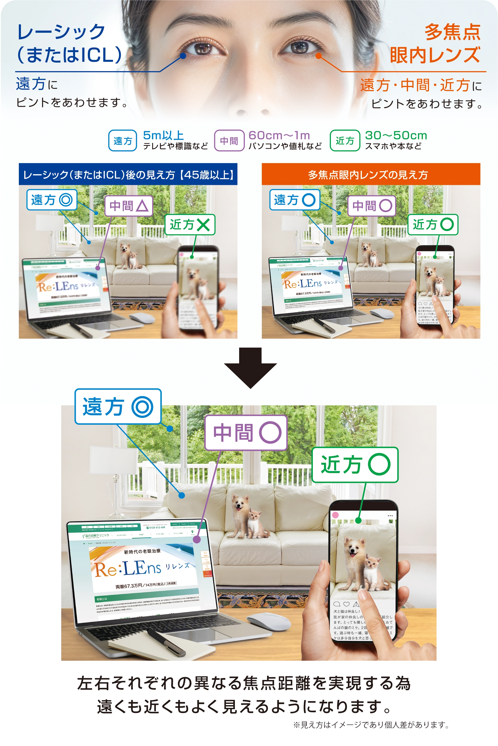 老眼治療 Re:LEns（リレンズ）術後の見え方