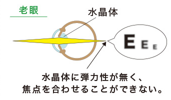 【老視】水晶体に弾力性が無いため、焦点を合わせる事ができない。