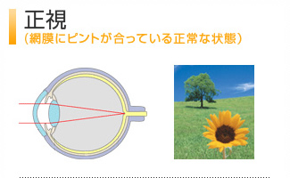 正視（網膜にピントが合っている正常な状態）