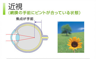 近視（網膜の手前にピントが合っている状態）