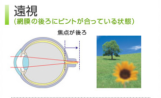 遠視（網膜に後ろにピントが合っている状態）