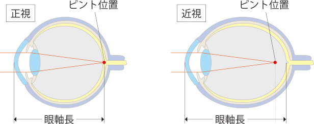 子どもの近視進行について