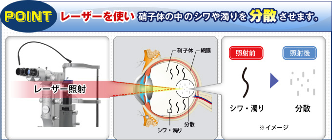 POINTレーザーを使い硝子体の中のシワや濁りを分散させます。