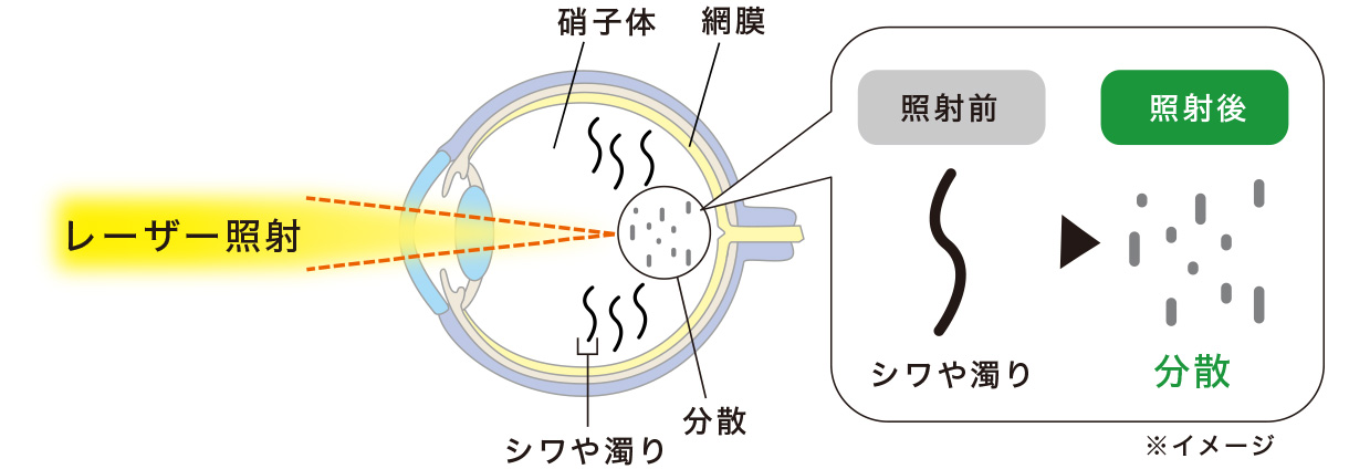 POINTレーザーを使い硝子体の中のシワや濁りを分散させます。
