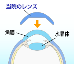 当院のレンズ