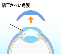 矯正された角膜