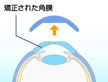 矯正された角膜