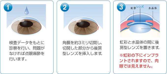 �@検査データをもとに診察を行い、問題がなければ点眼麻酔を行います。�A角膜を約3ミリ切開し、切開した部分から後房型レンズを挿入します。�B虹彩と水晶体の間に後房型レンズを置きます。※虹彩の下にインプラントされますので、肉眼では見えません。