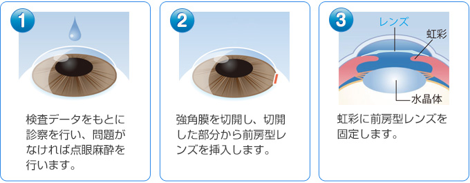 �@検査データをもとに診察を行い、問題がなければ点眼麻酔を行います。�A強角膜を約3ミリ切開し、切開した部分から後房型レンズを挿入します。�B虹彩に前房型レンズを固定します。