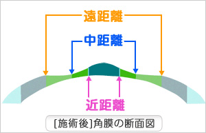 遠距離。中距離。近距離。【施術語】角膜の断面図