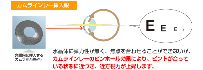 【カムラインレー挿入眼】水晶体に弾力性が無く、焦点を合わせることができないが、カムラインレーのピンホール効果により、ピントが合っている状態に近づき、近方視力が上昇します。