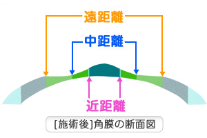 施術後の角膜の断面図