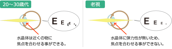 【若視】水晶体は近くの物に焦点を合わせる事ができる。【老視】水晶体に弾力性が無いため、焦点を合わせる事ができない。