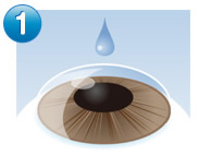 IPCL（老眼治療）手術の流れ1