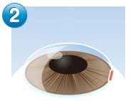 IPCL（老眼治療）手術の流れ2