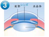 IPCL（老眼治療）手術の流れ3