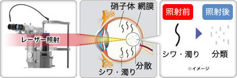 飛 蚊 症 治し 方 知恵袋